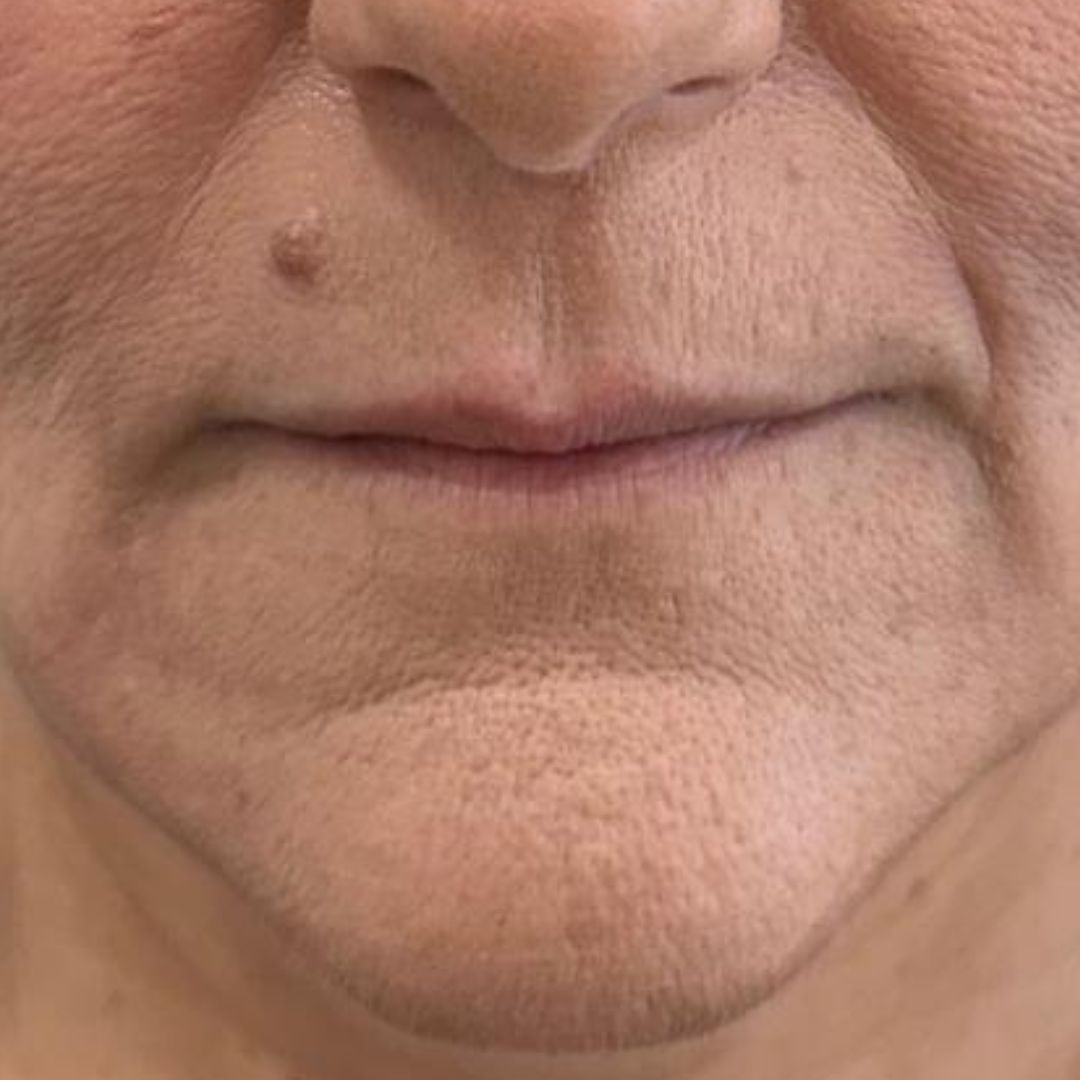 aumento-de-labios-huelva