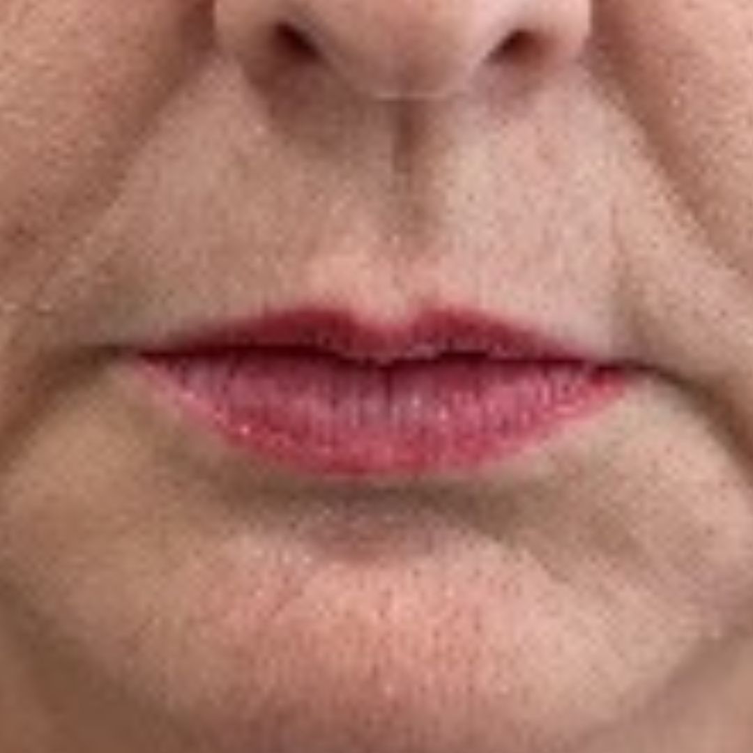 aumento-de-labios-huelva