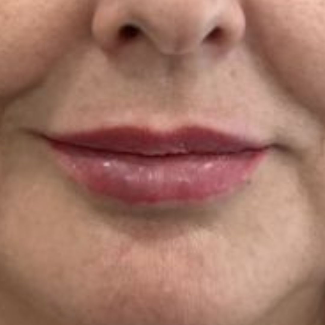 aumento-de-labios-huelva