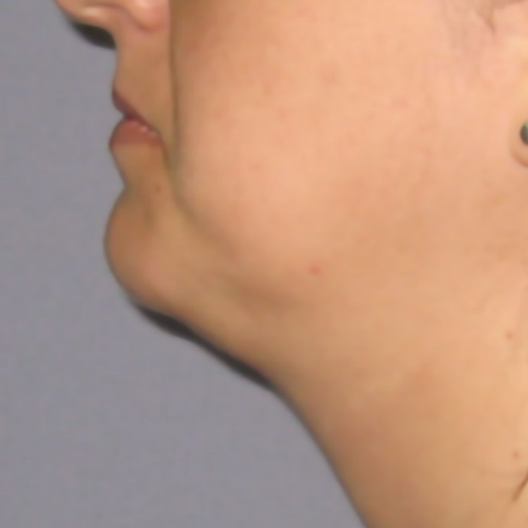 endolifting-facial-antes