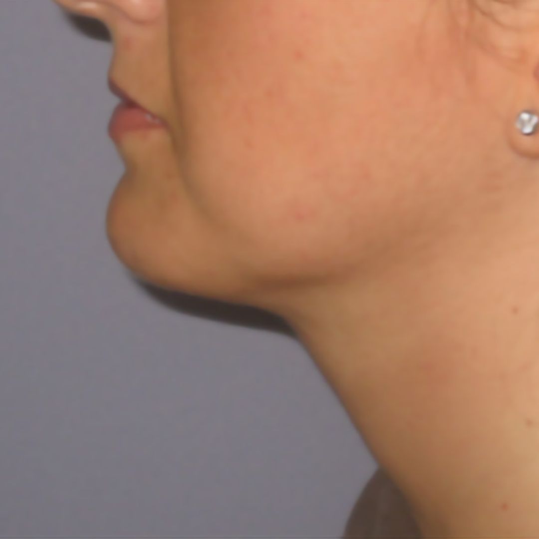 endolifting-facial-despues