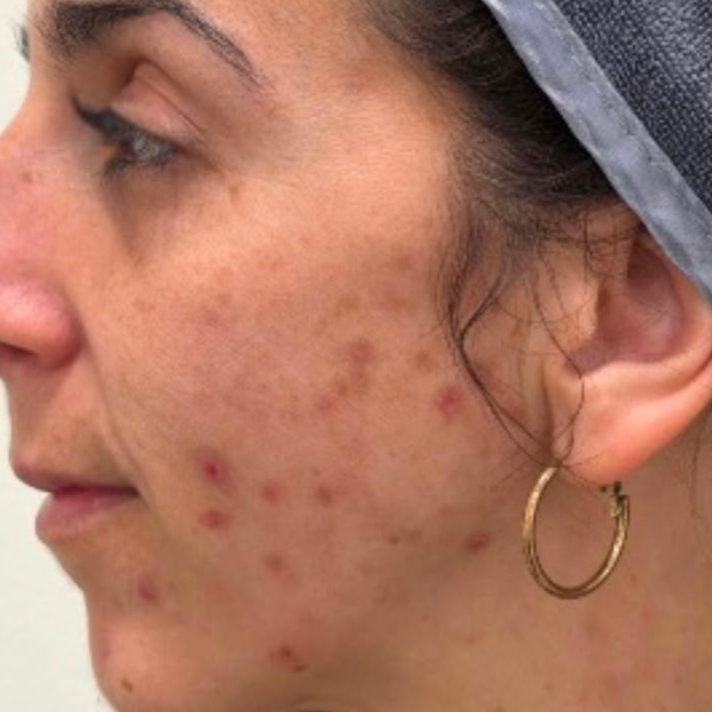 marcas-de-acne-ultraclear