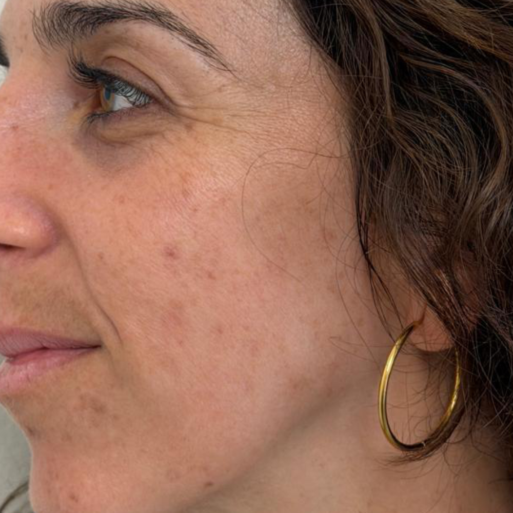 marcas-de-acne-ultraclear