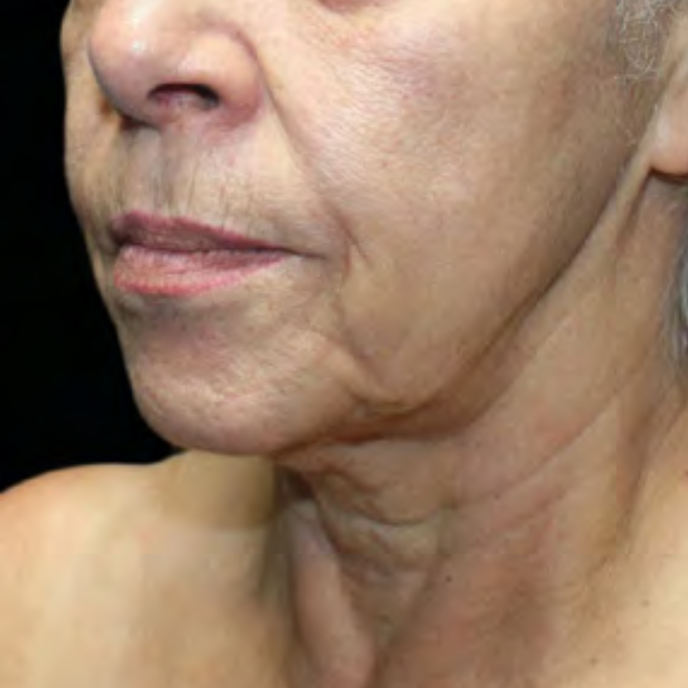 flacidez-ultraclear