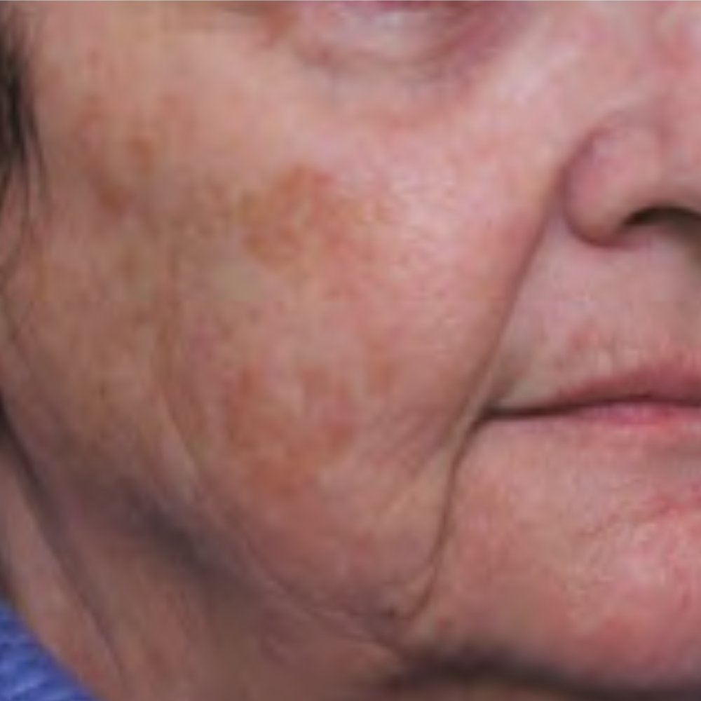 laser-frio-ultraclear